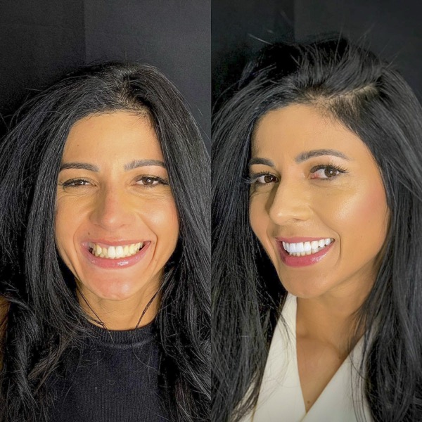 Transformação do sorriso — resultado real de paciente da Odonto Spazzio