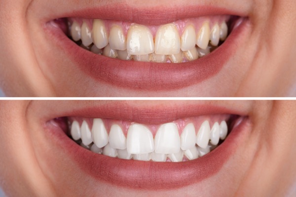 Clareamento dental em Recife — Odonto Spazzio
