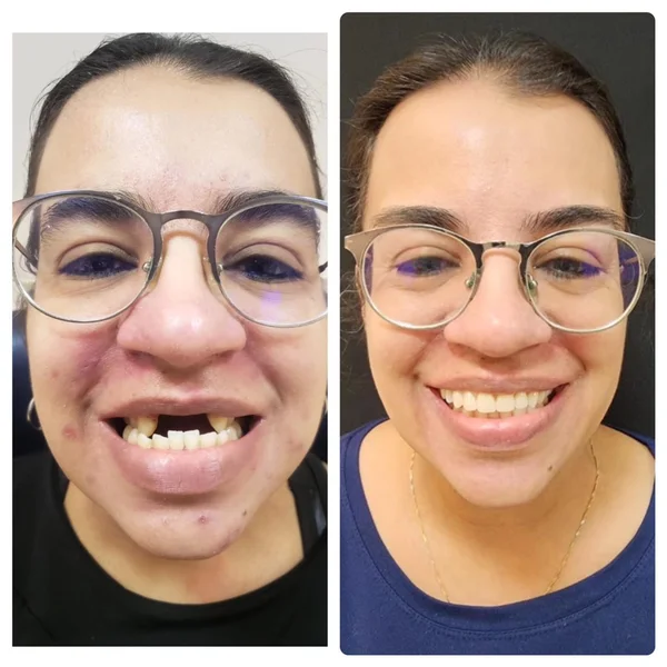Fernanda, 36 anos — paciente da Odonto Spazzio em Recife