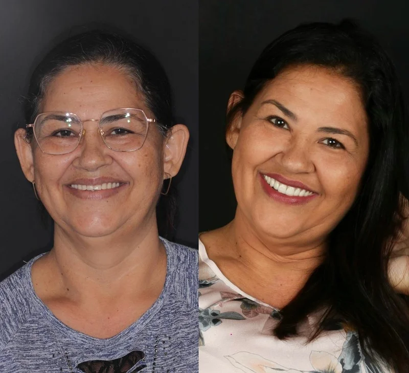 Paciente recuperou o sorriso e a confiança na Odonto Spazzio em Recife